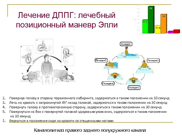 Маневр эпле. Метод Эпли при головокружении. ДППГ лечение. Позиционные маневры ДППГ. Позиционный маневр Эпли.