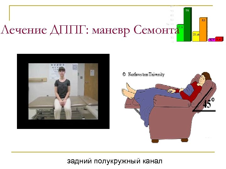 Лечение ДППГ: маневр Семонта задний полукружный канал 