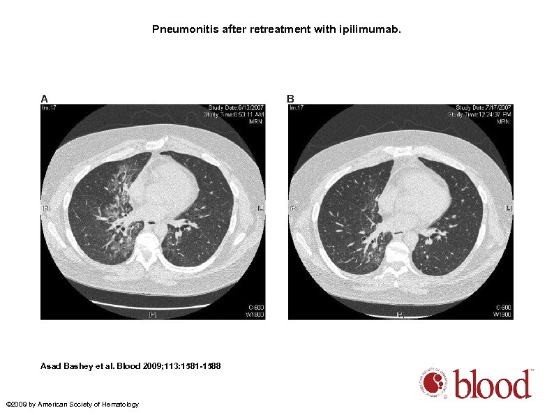 Pneumonitis after retreatment with ipilimumab. Asad Bashey et al. Blood 2009; 113: 1581 -1588