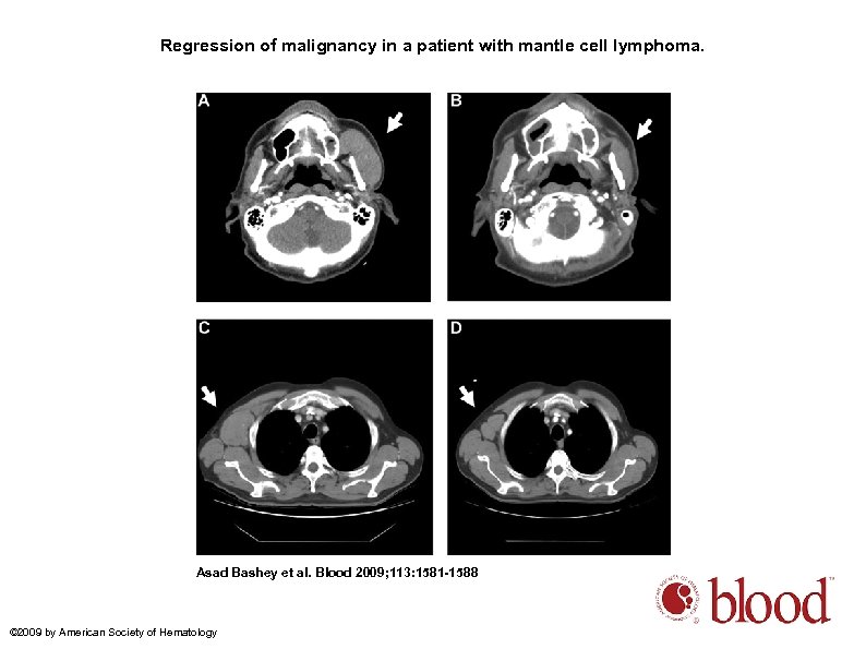 Regression of malignancy in a patient with mantle cell lymphoma. Asad Bashey et al.