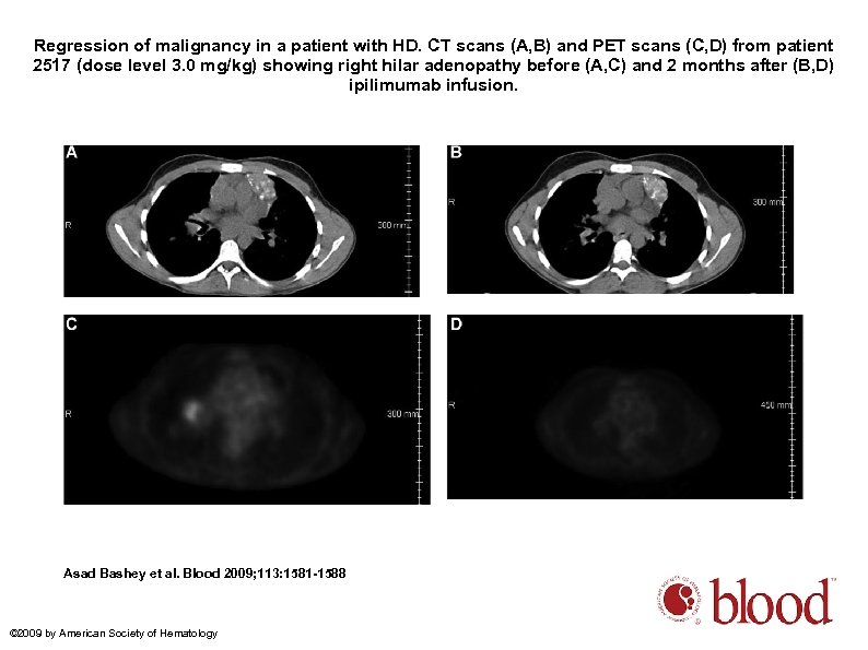 Regression of malignancy in a patient with HD. CT scans (A, B) and PET