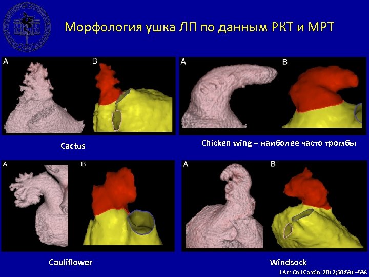 Морфология ушка ЛП по данным РКТ и МРТ Cactus Cauliflower Chicken wing – наиболее