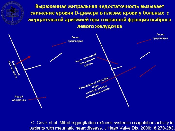 Выраженная митральная недостаточность вызывает снижение уровня D-димера в плазме крови у больных с мерцательной