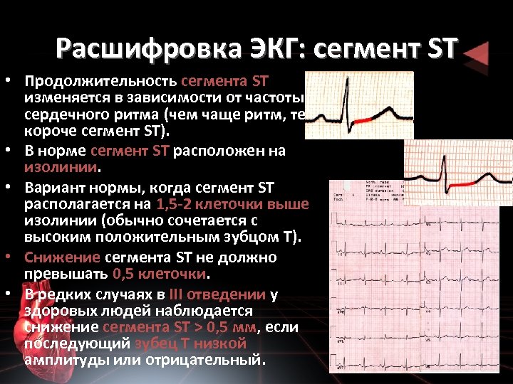 Расшифровка ЭКГ: сегмент ST • Продолжительность сегмента ST изменяется в зависимости от частоты сердечного