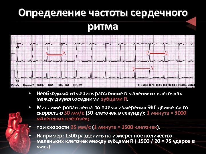 Как измерить частоту сердечных. Формула ЧСС по ЭКГ 25 мм. Частота сердечных сокращений на ЭКГ 50мм. Подсчет ЧСС на ЭКГ 50 мм/с. Подсчет ЧСС на ЭКГ 25 мм/с.