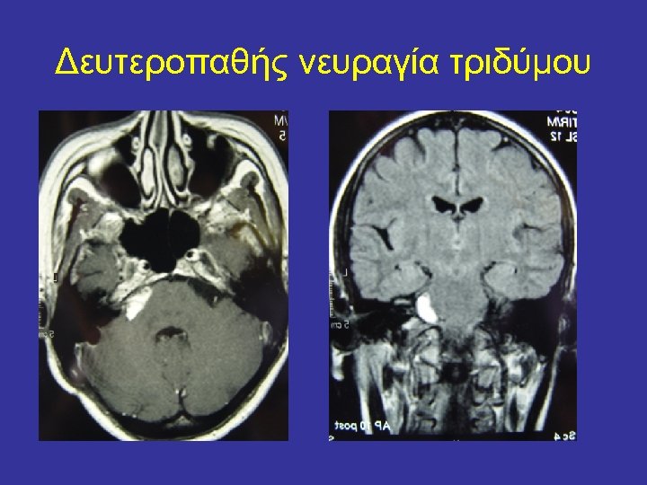 Δευτεροπαθής νευραγία τριδύμου 