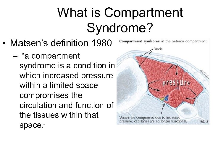 What is Compartment Syndrome? • Matsen’s definition 1980 – “a compartment syndrome is a