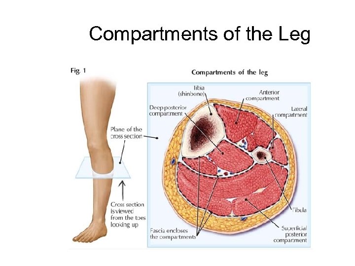 posterior thigh compartment syndrome