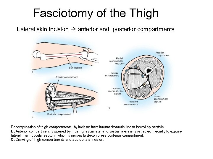 lower extremity compartments fasciotomy