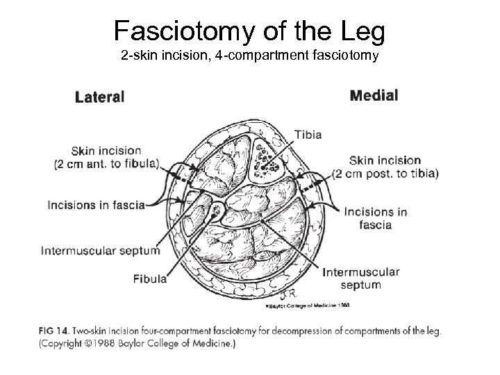 Fasciotomy of the Leg 2 -skin incision, 4 -compartment fasciotomy 