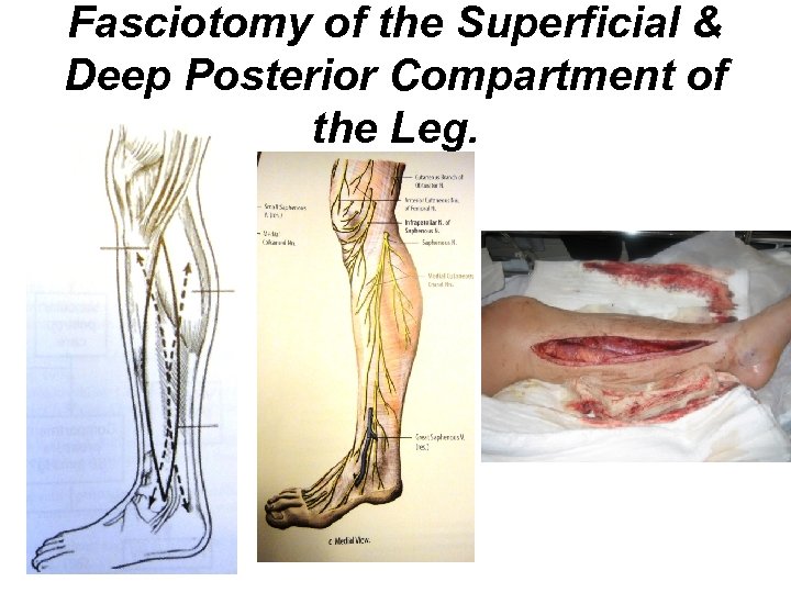 Fasciotomy of the Superficial & Deep Posterior Compartment of the Leg. 