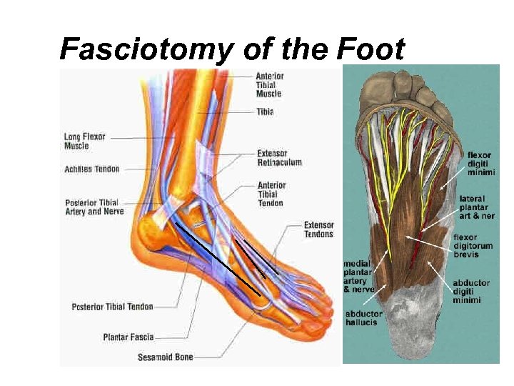 Fasciotomy of the Foot 