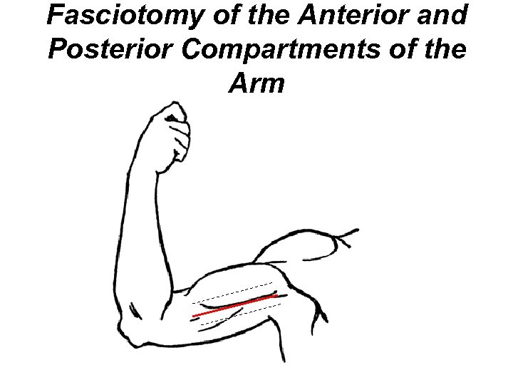 Fasciotomy of the Anterior and Posterior Compartments of the Arm 