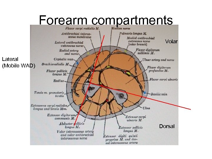 Forearm compartments Volar Lateral (Mobile WAD) Dorsal 