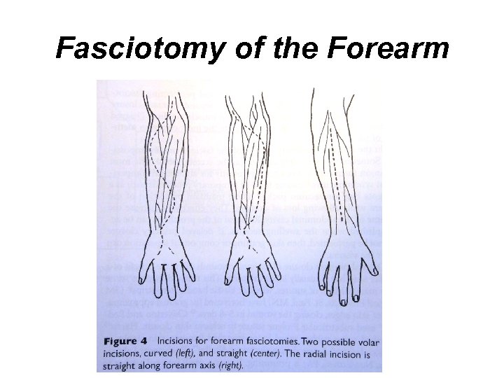 Compartment Syndrome And Fasciotomy Supparerk Prichayudh M D