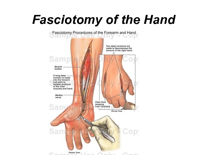 Fasciotomy of the Hand 