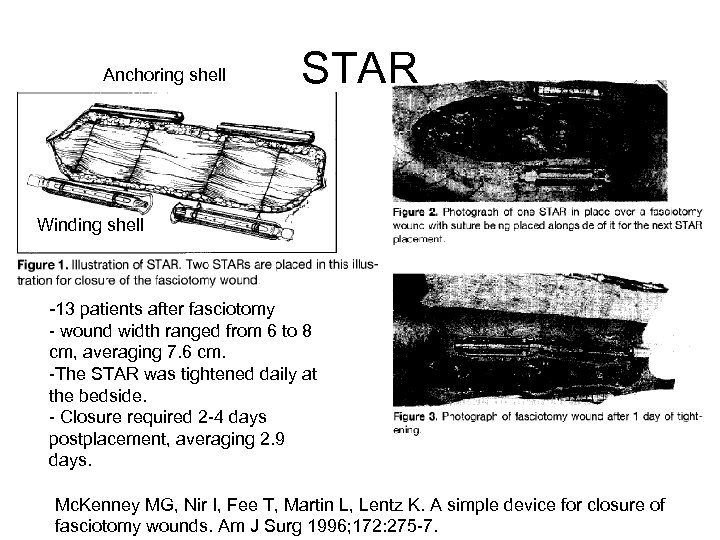 Anchoring shell STAR Winding shell -13 patients after fasciotomy - wound width ranged from