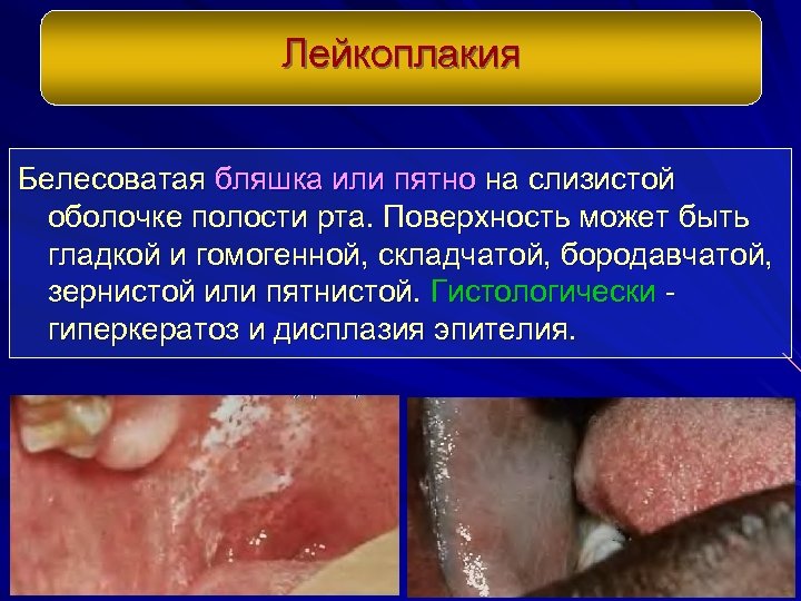 Лейкоплакия Белесоватая бляшка или пятно на слизистой оболочке полости рта. Поверхность может быть гладкой