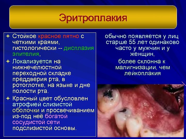 Эритроплакия ª Стойкое красное пятно с четкими краями, гистологически -- дисплазия эпителия, ª Локализуется