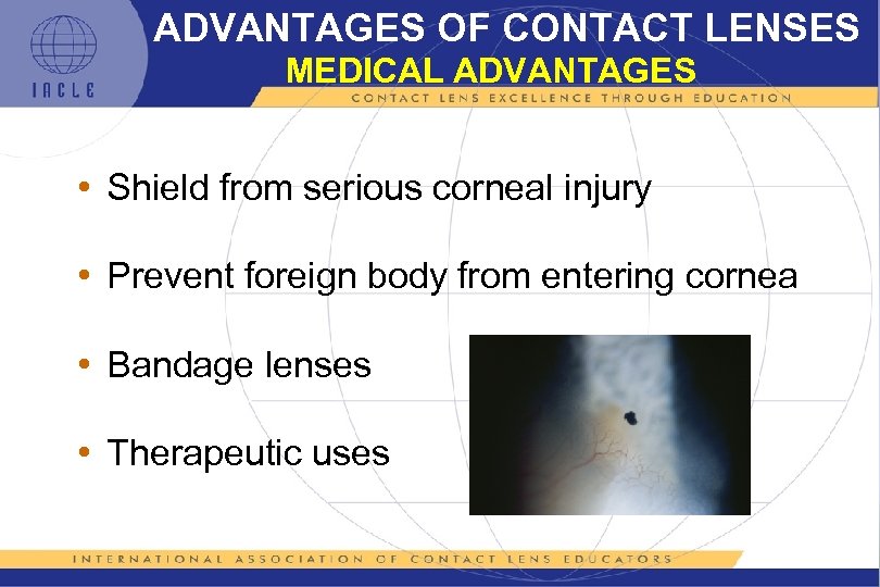 ADVANTAGES OF CONTACT LENSES MEDICAL ADVANTAGES • Shield from serious corneal injury • Prevent