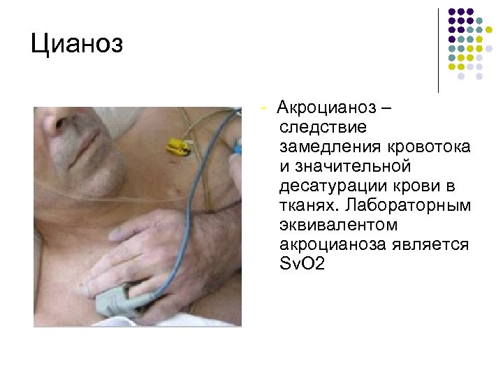 Цианоз - Акроцианоз – следствие замедления кровотока и значительной десатурации крови в тканях. Лабораторным