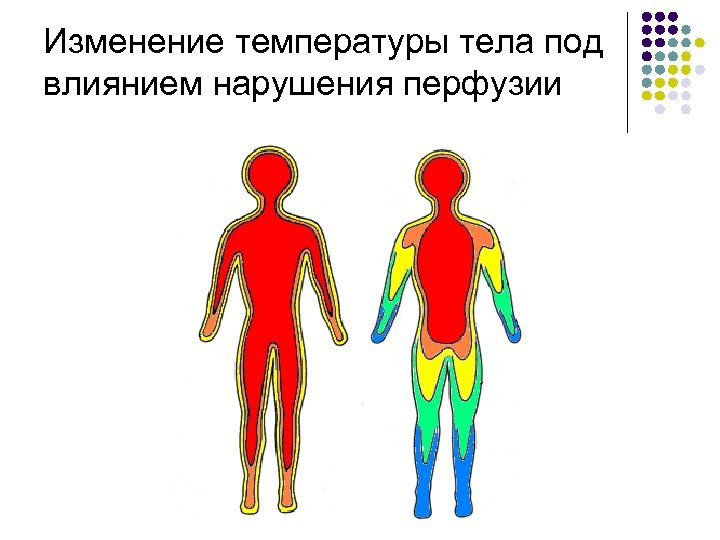 Изменение температуры тела под влиянием нарушения перфузии 