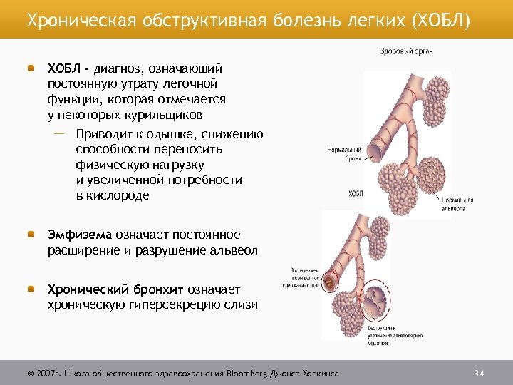 Хроническая обструктивная болезнь легких картинки