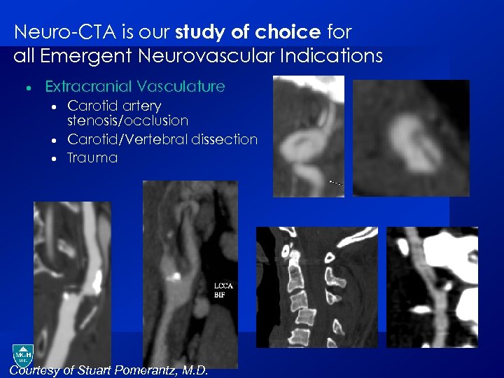 Neuro-CTA is our study of choice for all Emergent Neurovascular Indications · Extracranial Vasculature