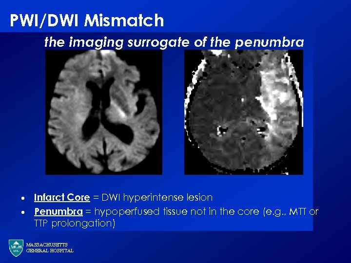 PWI/DWI Mismatch the imaging surrogate of the penumbra · · Infarct Core = DWI