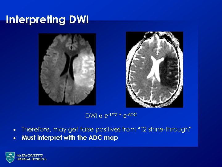 Interpreting DWI ⍺ e-1/T 2 * e-ADC · · Therefore, may get false positives