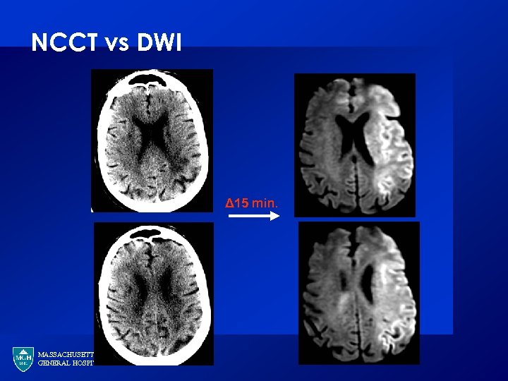 NCCT vs DWI Δ 15 min. MASSACHUSETTS GENERAL HOSPITAL 