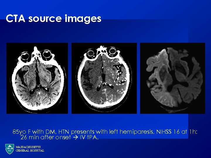 CTA source images MGH 85 yo F with DM, HTN presents with left hemiparesis,