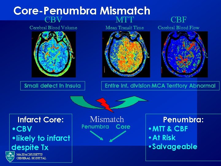 Core-Penumbra Mismatch CBV MTT CBF Cerebral Blood Volume Mean Transit Time Cerebral Blood Flow