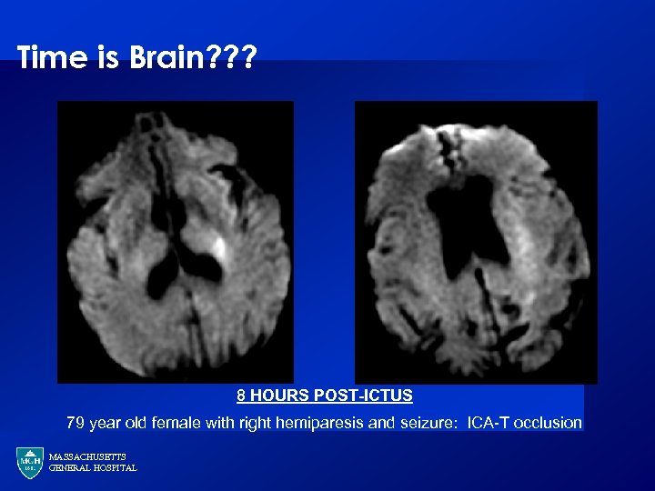 Time is Brain? ? ? 8 HOURS POST-ICTUS 79 year old female with right