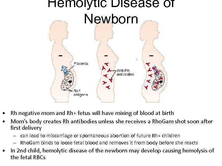 Hemolytic Disease of Newborn • Rh negative mom and Rh+ fetus will have mixing