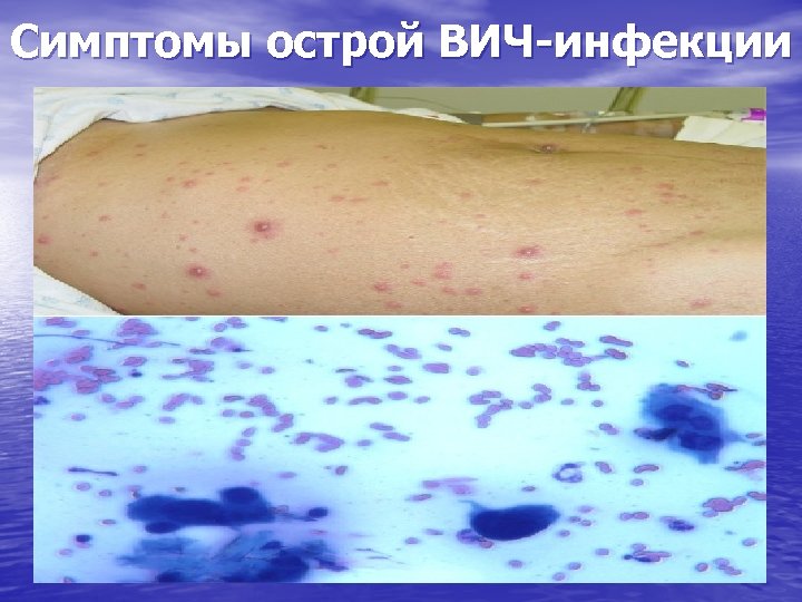 Симптомы острой ВИЧ-инфекции 
