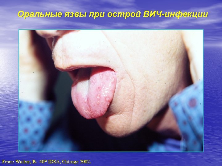Оральные язвы при острой ВИЧ-инфекции From: Walker, B. 40 th IDSA, Chicago 2002. 