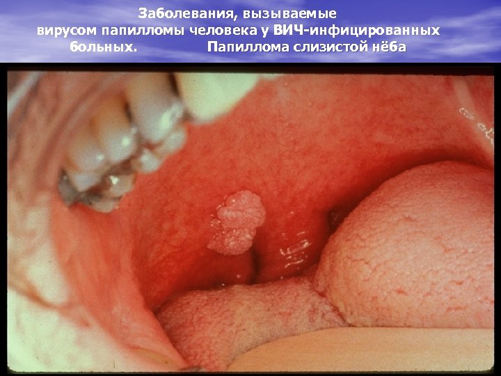 Заболевания, вызываемые вирусом папилломы человека у ВИЧ-инфицированных больных. Папиллома слизистой нёба 