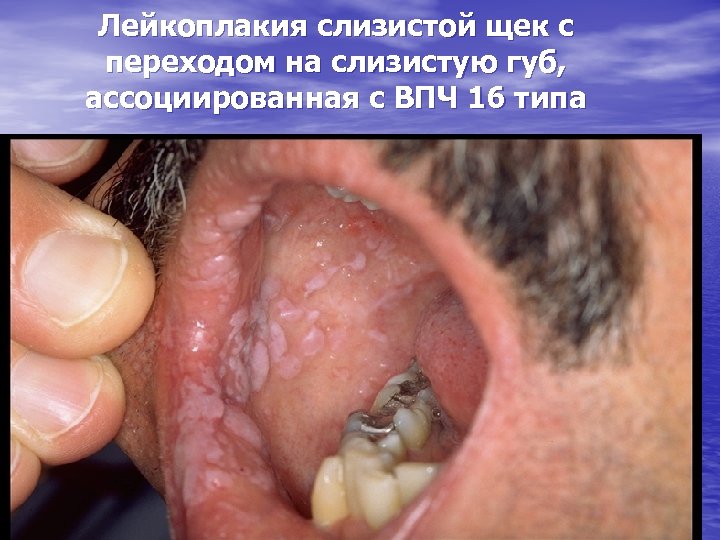 Лейкоплакия слизистой щек с переходом на слизистую губ, ассоциированная с ВПЧ 16 типа 
