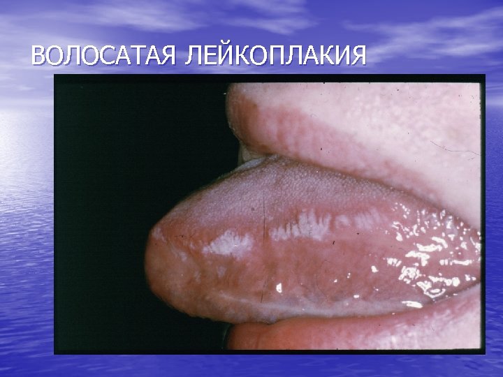 ВОЛОСАТАЯ ЛЕЙКОПЛАКИЯ 