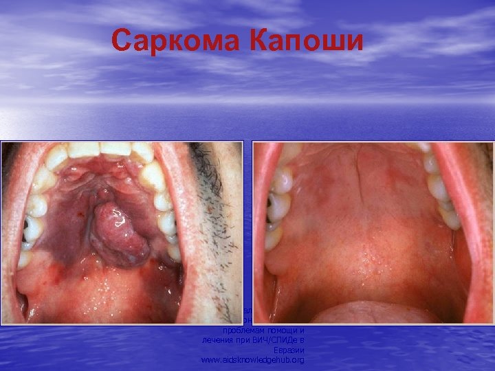 Саркома Капоши Региональный Учебно. Информационный Центр по проблемам помощи и лечения при ВИЧ/СПИДе в