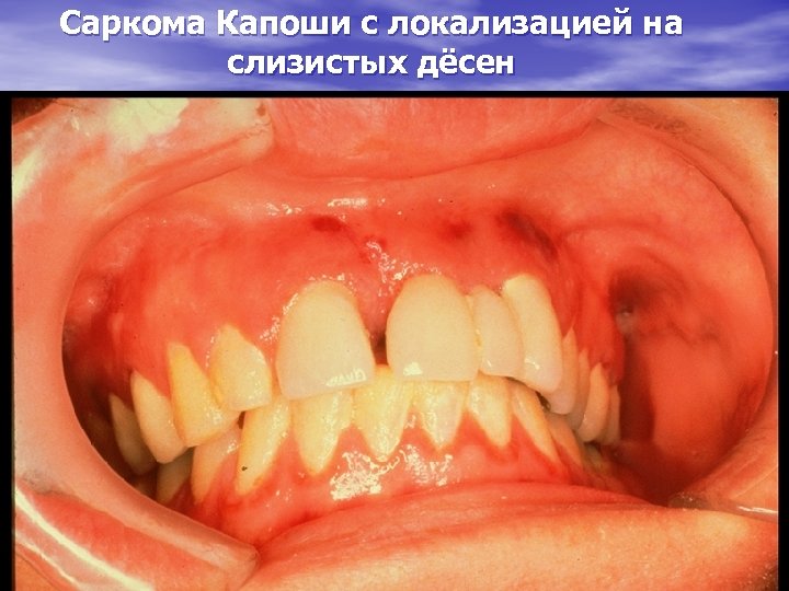Саркома Капоши с локализацией на слизистых дёсен 
