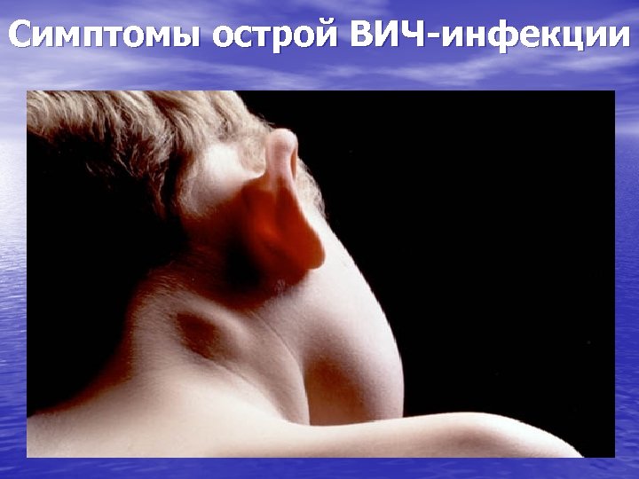 Симптомы острой ВИЧ-инфекции 