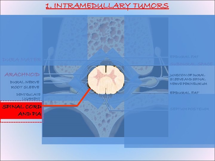 1. INTRAMEDULLARY TUMORS DURA MATER ARACHNOID DURAL NERVE ROOT SLEEVE DENTICULATE LIGAMENT SPINAL CORD