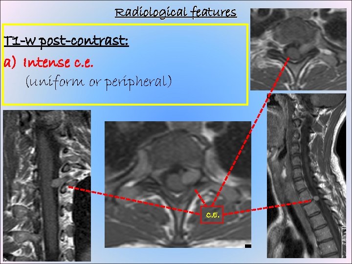 Radiological features T 1 -w post-contrast: a) Intense c. e. (uniform or peripheral) C.