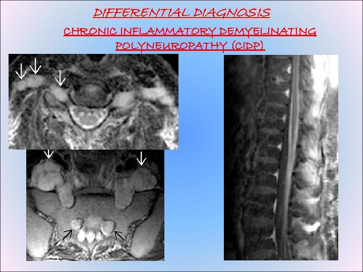DIFFERENTIAL DIAGNOSIS CHRONIC INFLAMMATORY DEMYELINATING POLYNEUROPATHY (CIDP) 