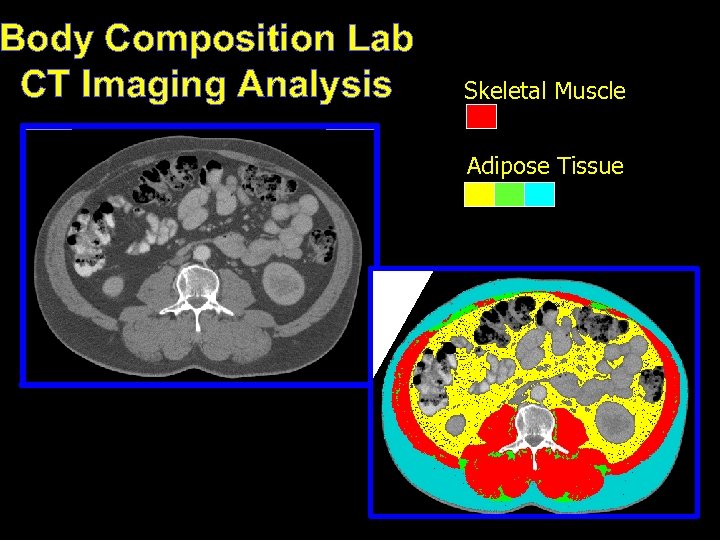 Body Composition Lab CT Imaging Analysis Skeletal Muscle Adipose Tissue 