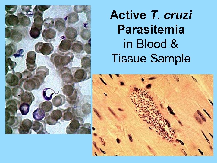 Active T. cruzi Parasitemia in Blood & Tissue Sample 