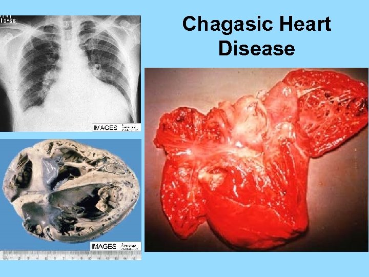 Chagasic Heart Disease 