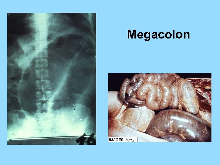 Megacolon 